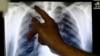 Study: Anti-smoking Strategies Critical to TB and HIV Care 