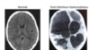 Hydrocephalus, or water on the brain, affects 100,000 children every year in Africa alone. (Credit: Schiff)